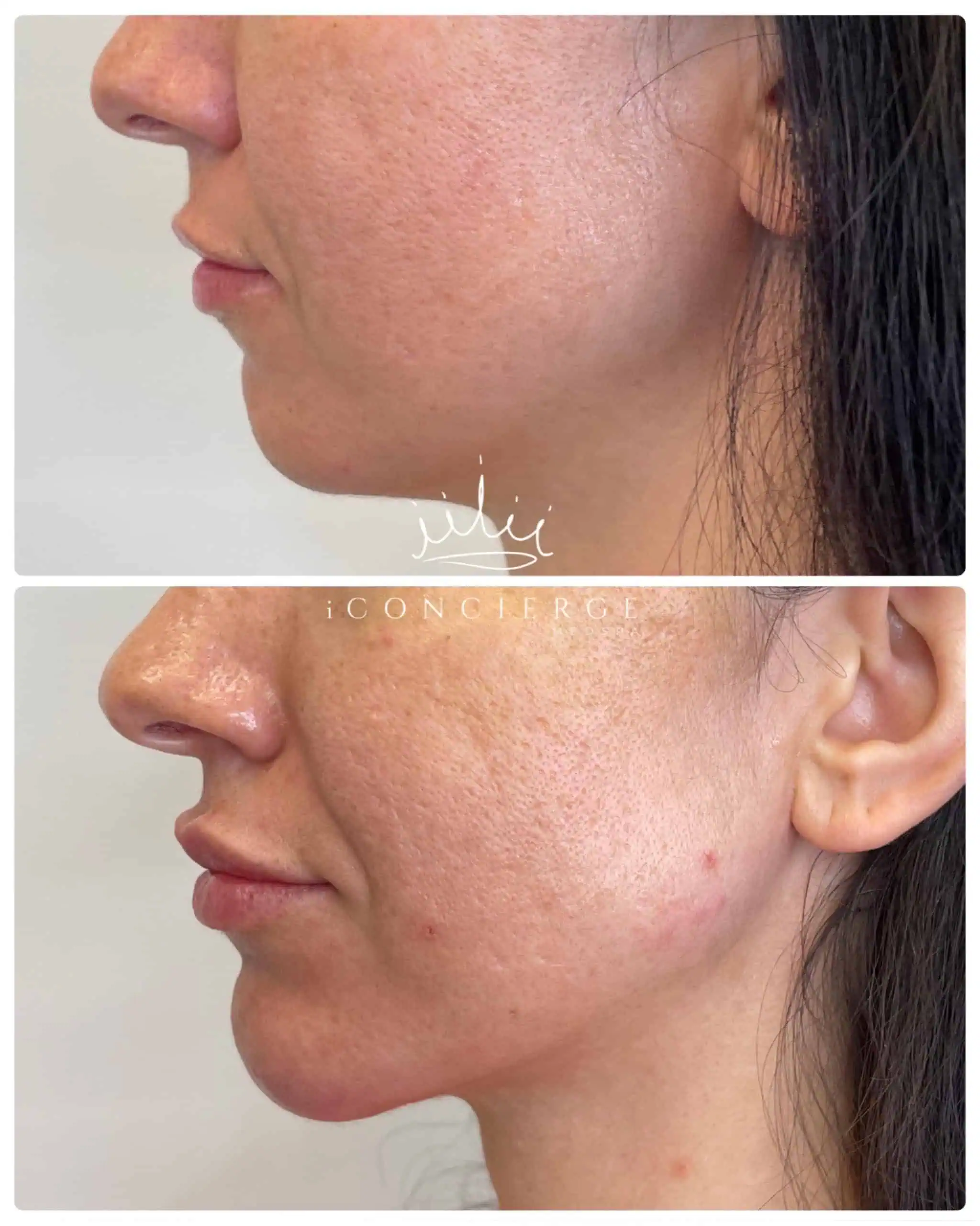 Facial Balancing Before and After in St. Petersburg, FL | iConcierge Medspa