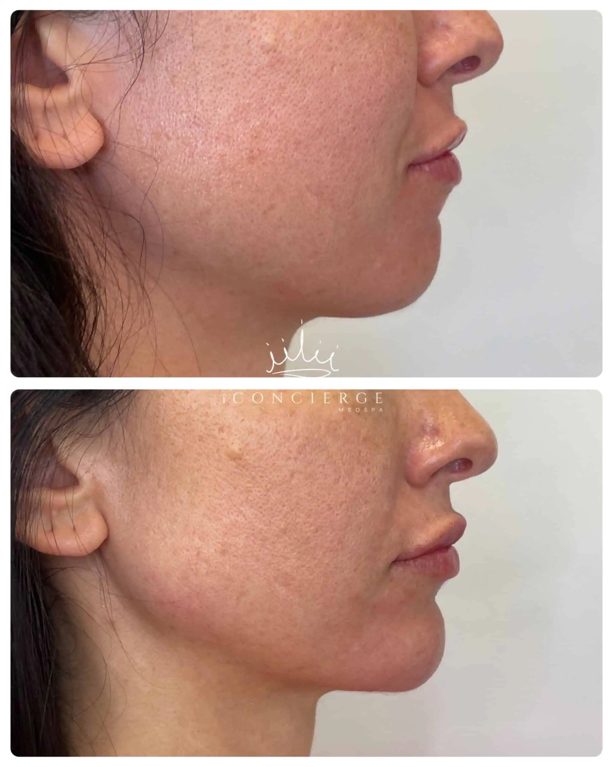 Facial Balancing Before and After in St. Petersburg, FL | iConcierge Medspa