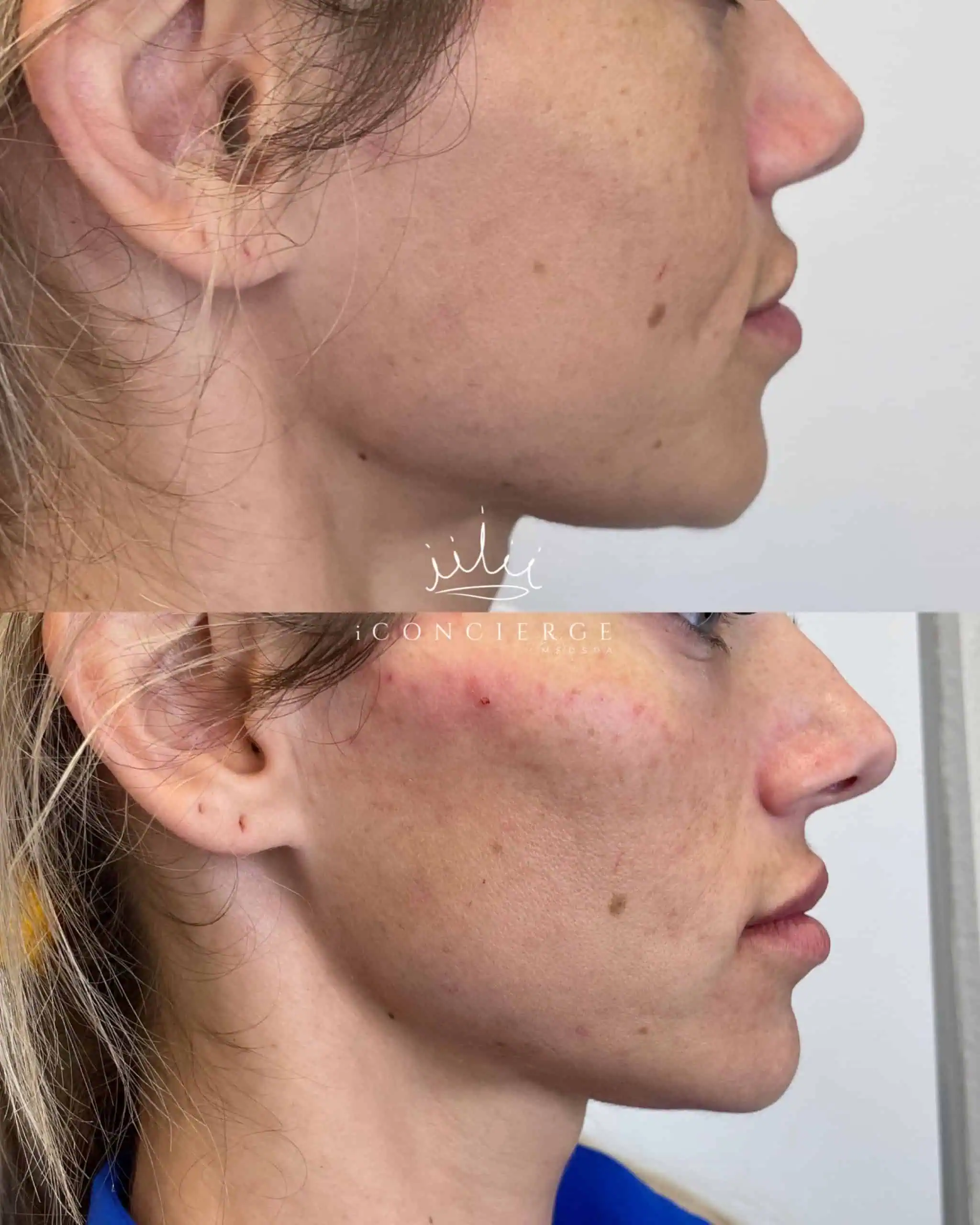 Facial Balancing Before and After in St. Petersburg, FL | iConcierge Medspa