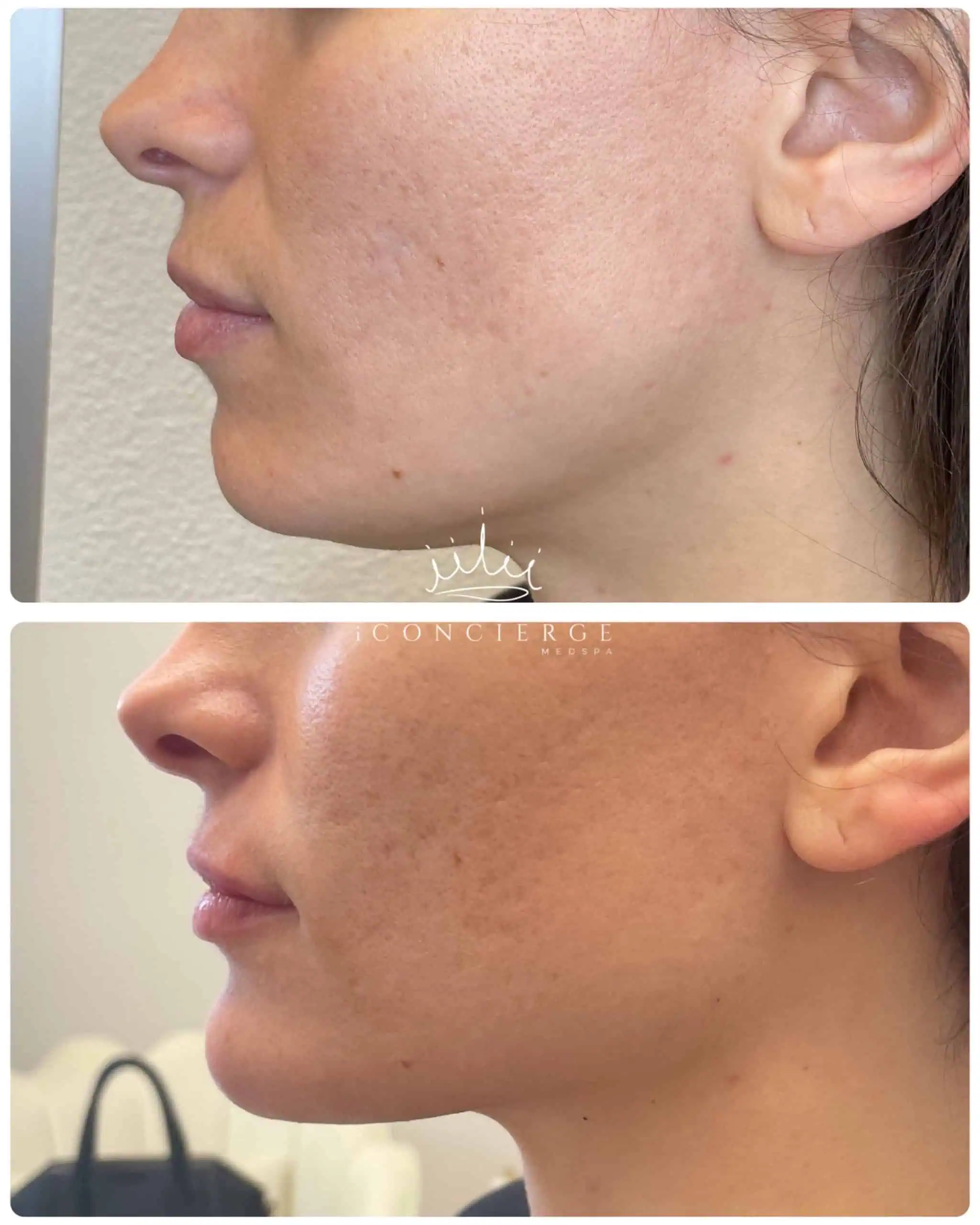 Facial Balancing Before and After in St. Petersburg, FL | iConcierge Medspa