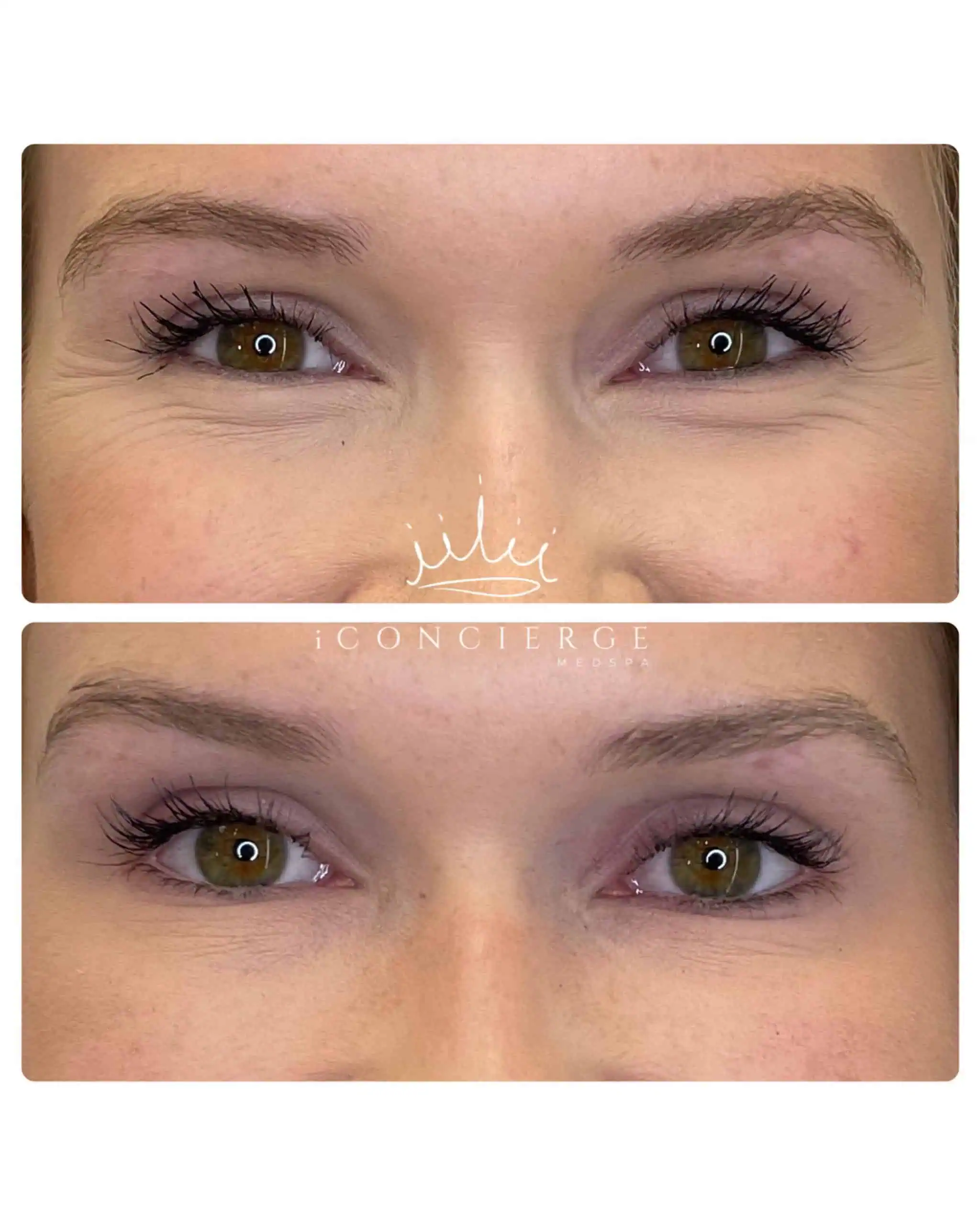 Botox Before and After in St. Petersburg, FL | iConcierge Medspa