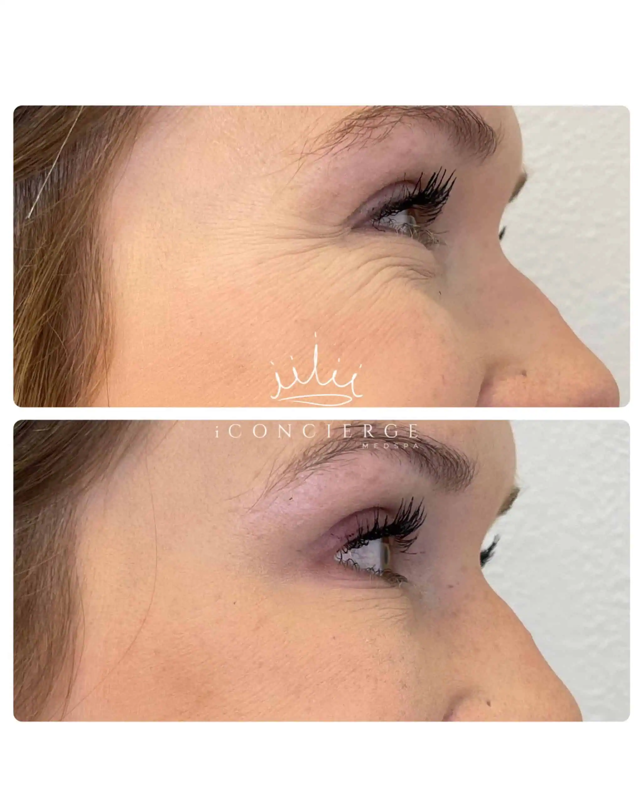 Botox Before and After in St. Petersburg, FL | iConcierge Medspa