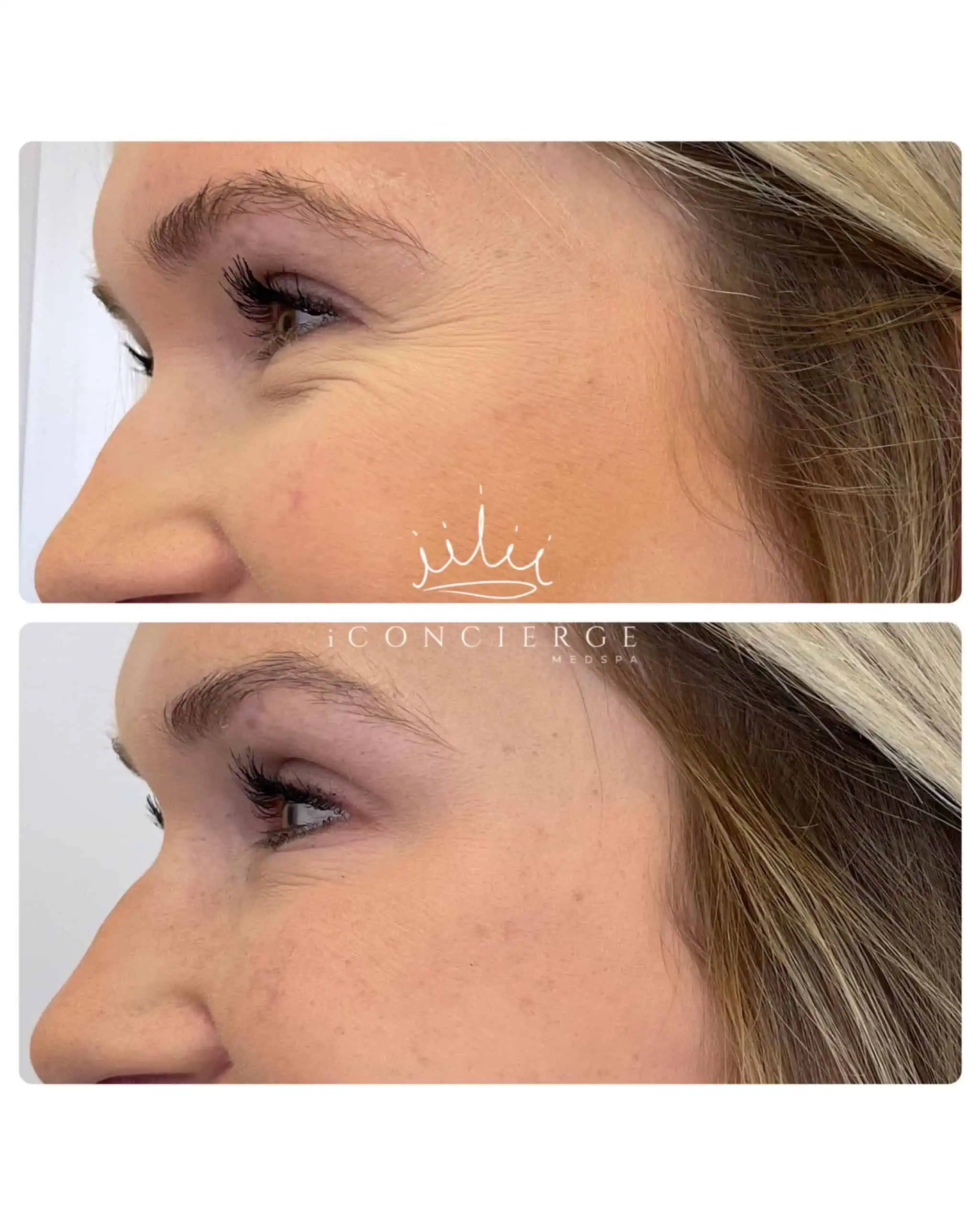 Botox Before and After in St. Petersburg, FL | iConcierge Medspa