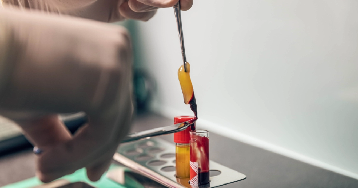 Medical professional handling a PRF sample, showing yellow fibrin clot in test tubes in St Petersburg