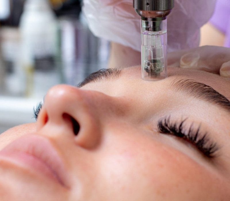 Microneedling-scaled