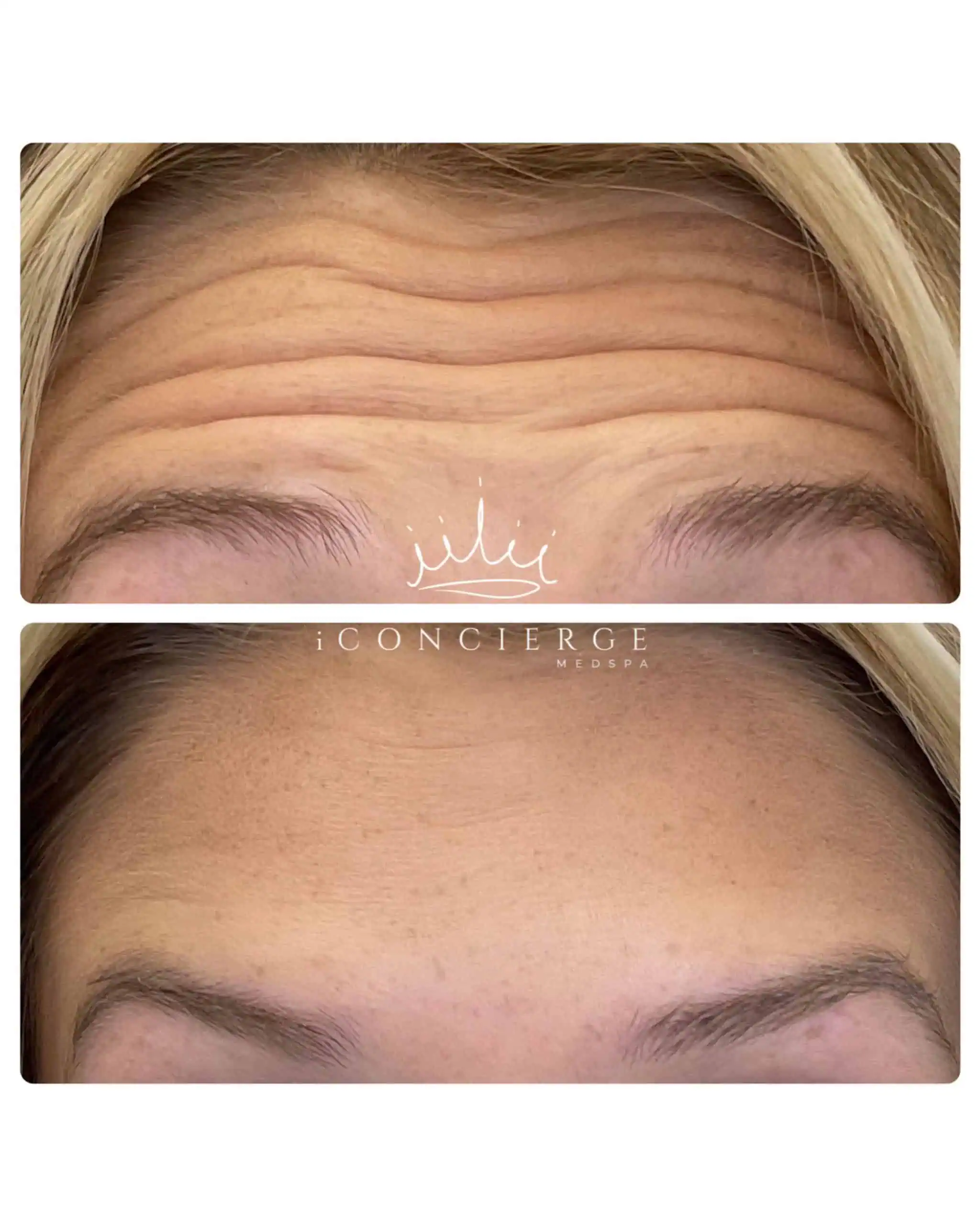 Botox Before and After in St. Petersburg, FL | iConcierge Medspa