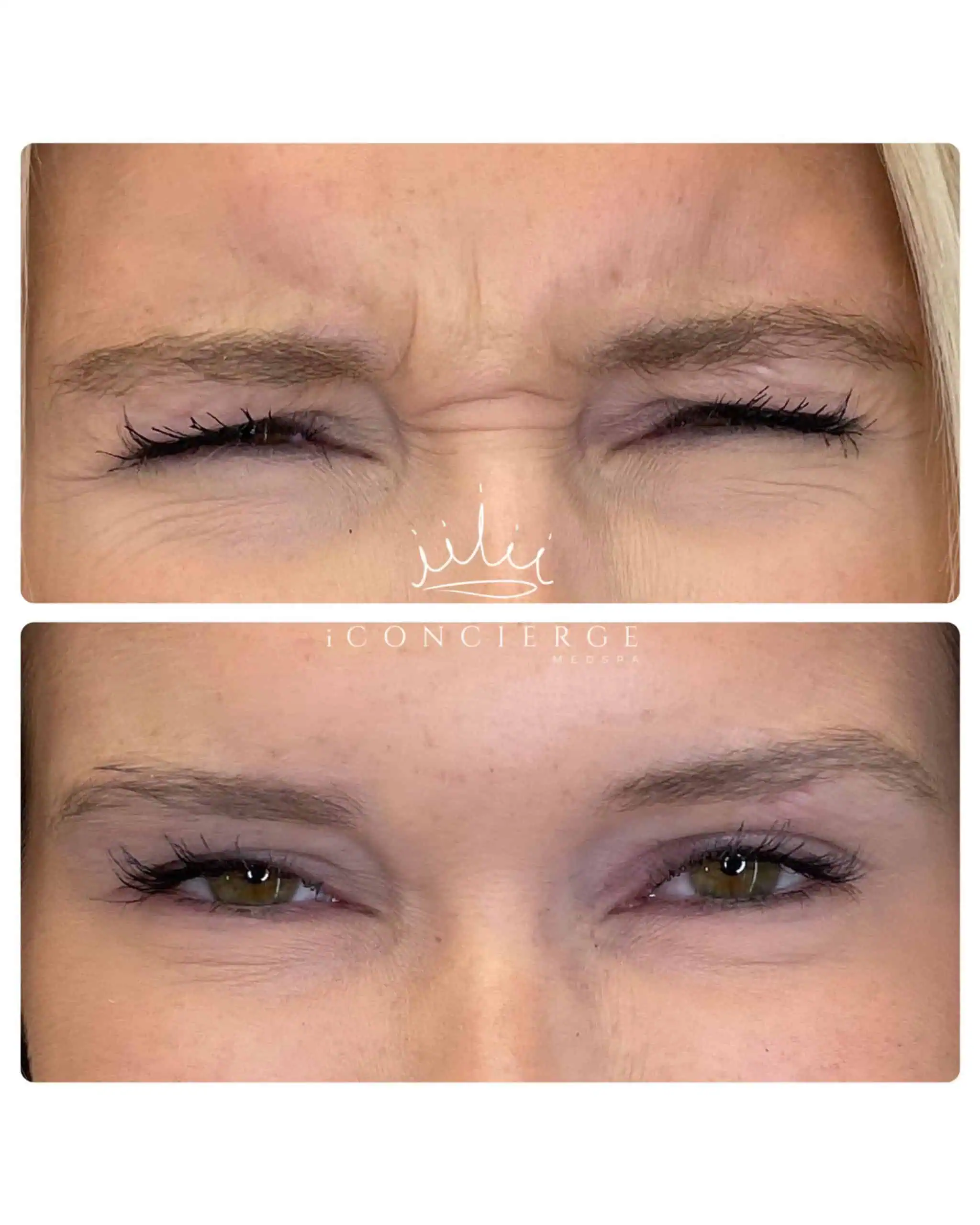 Botox Before and After in St. Petersburg, FL | iConcierge Medspa