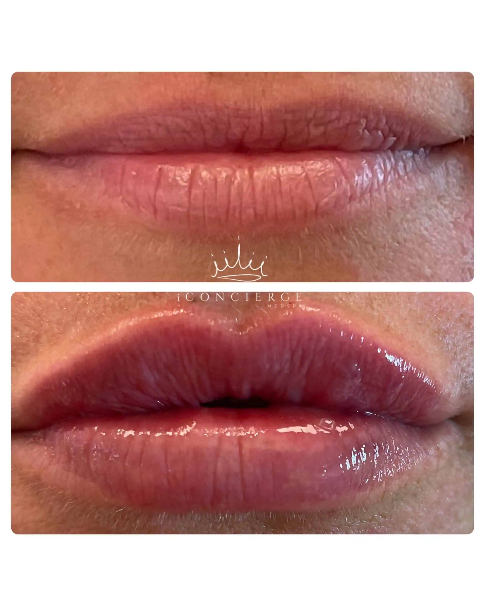 Lip Filler Before and After in St. Petersburg, FL | iConcierge Medspa