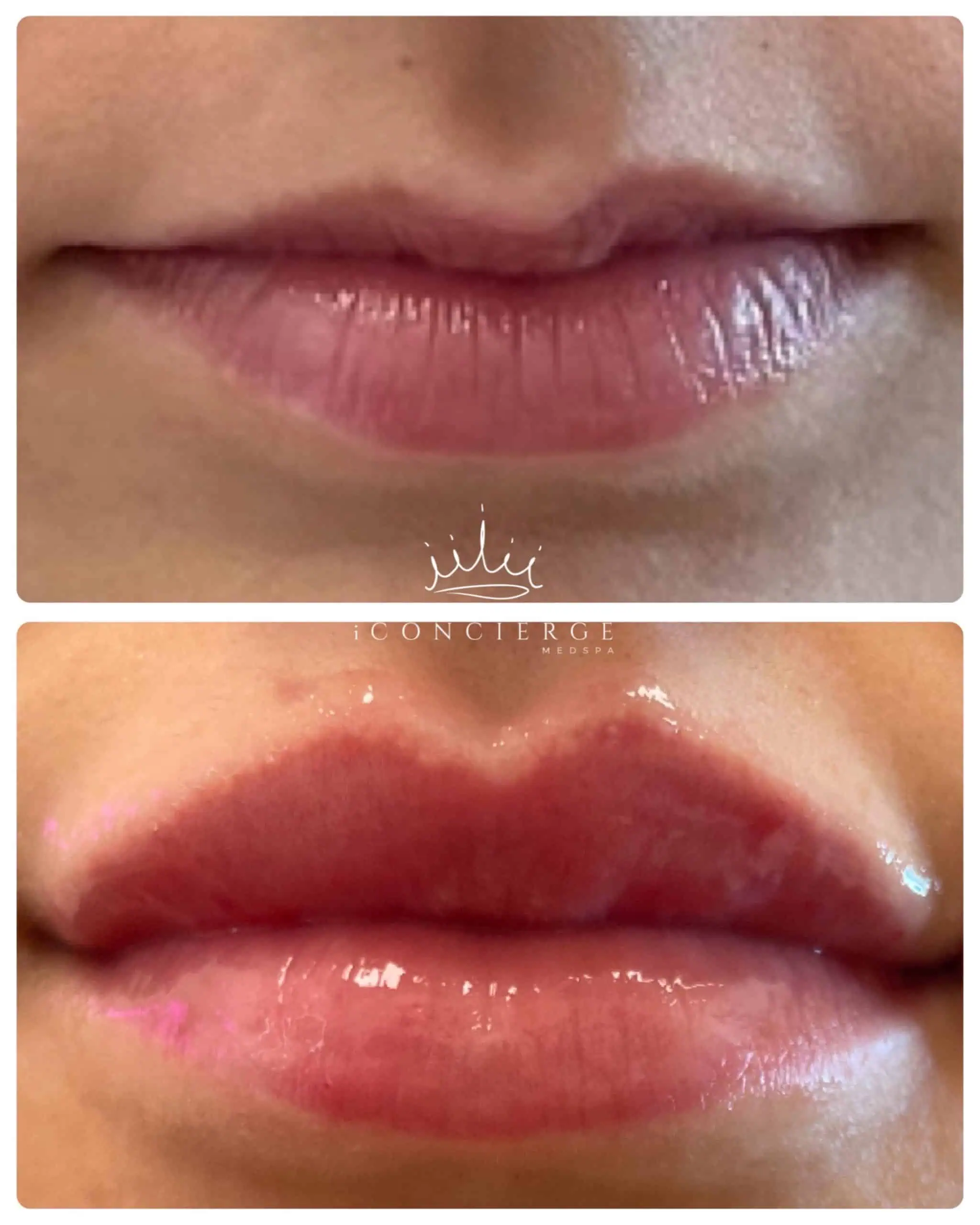 Lip Filler Before and After in St. Petersburg, FL | iConcierge Medspa