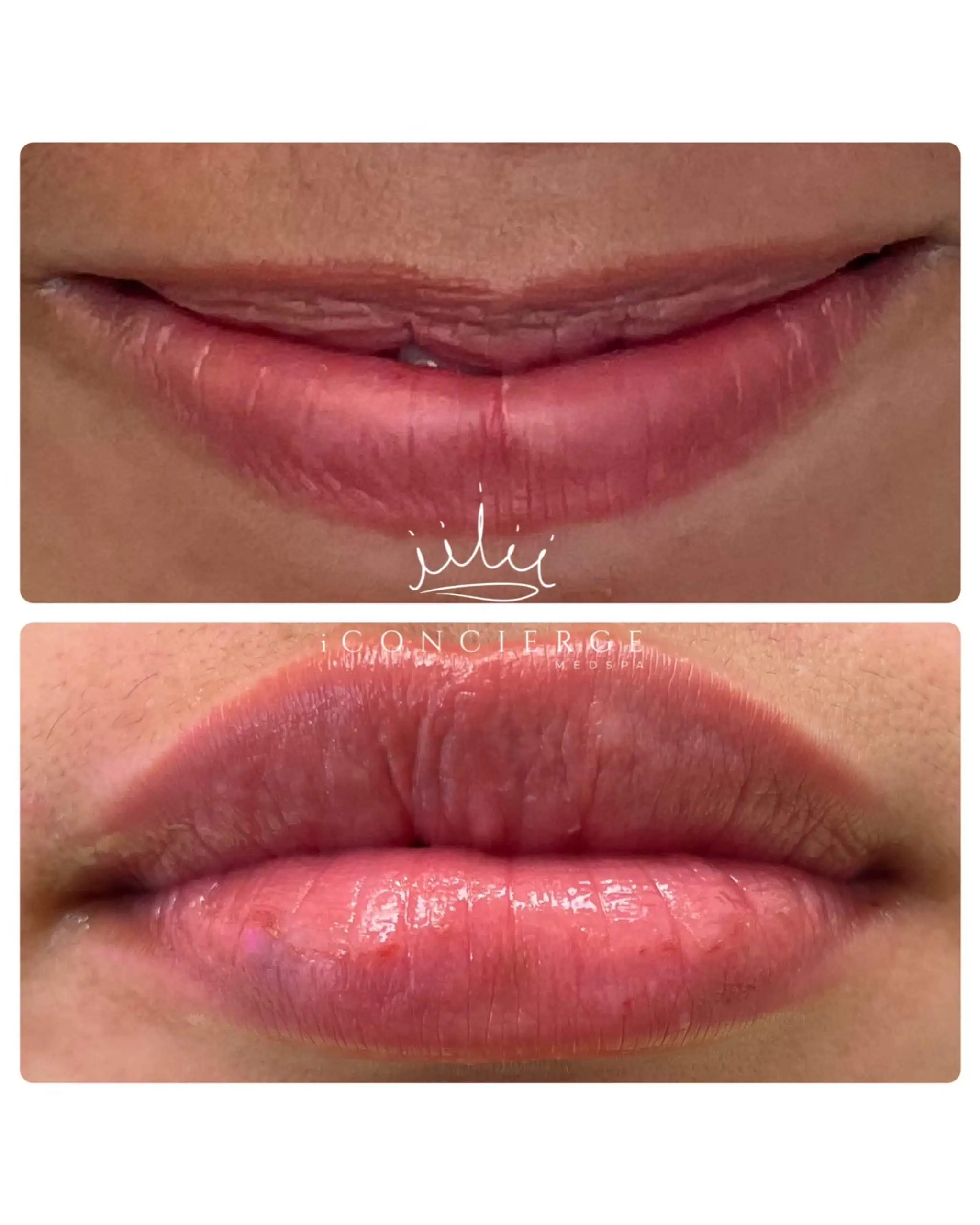 Lip Filler Before and After in St. Petersburg, FL | iConcierge Medspa