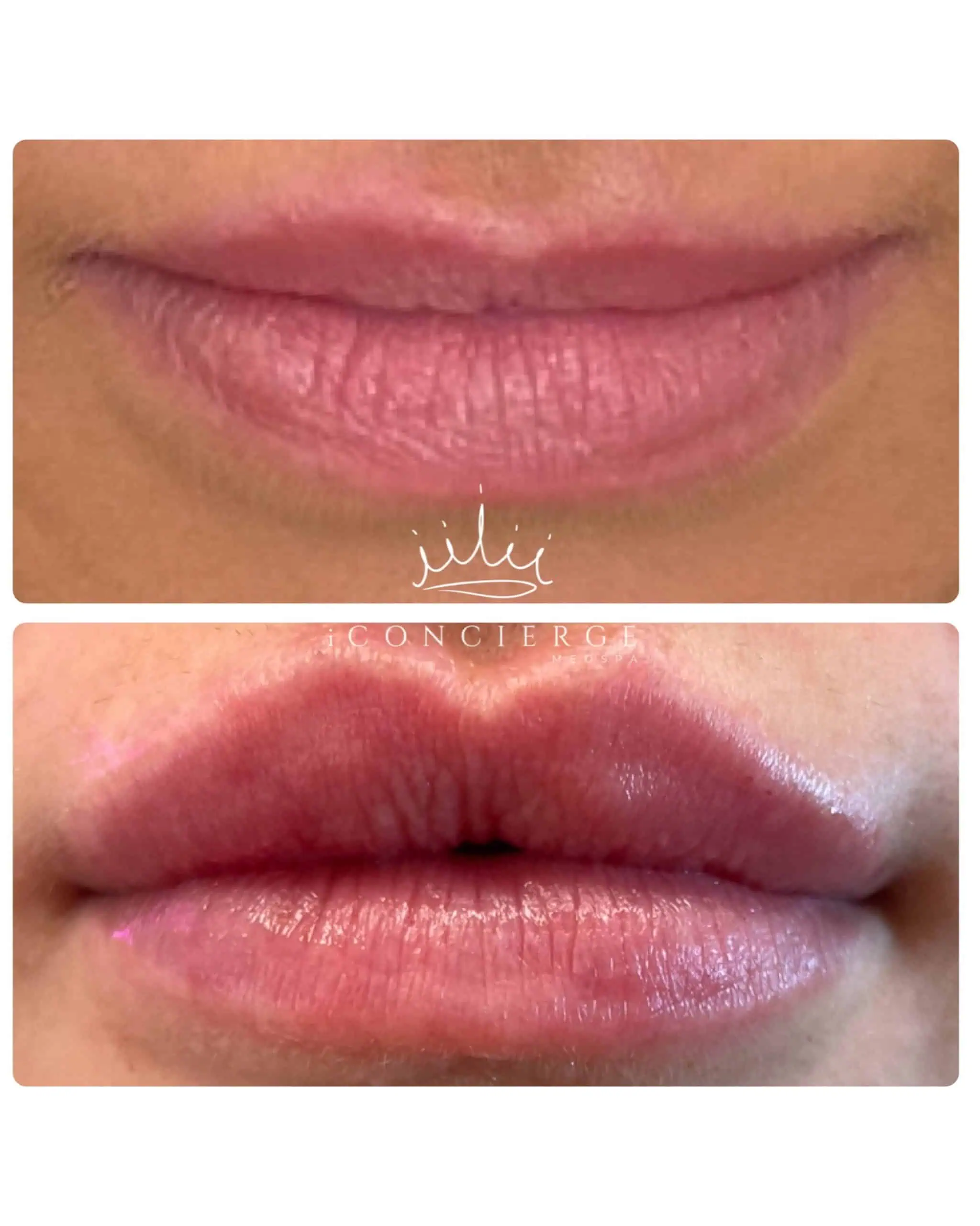 Lip Filler Before and After in St. Petersburg, FL | iConcierge Medspa