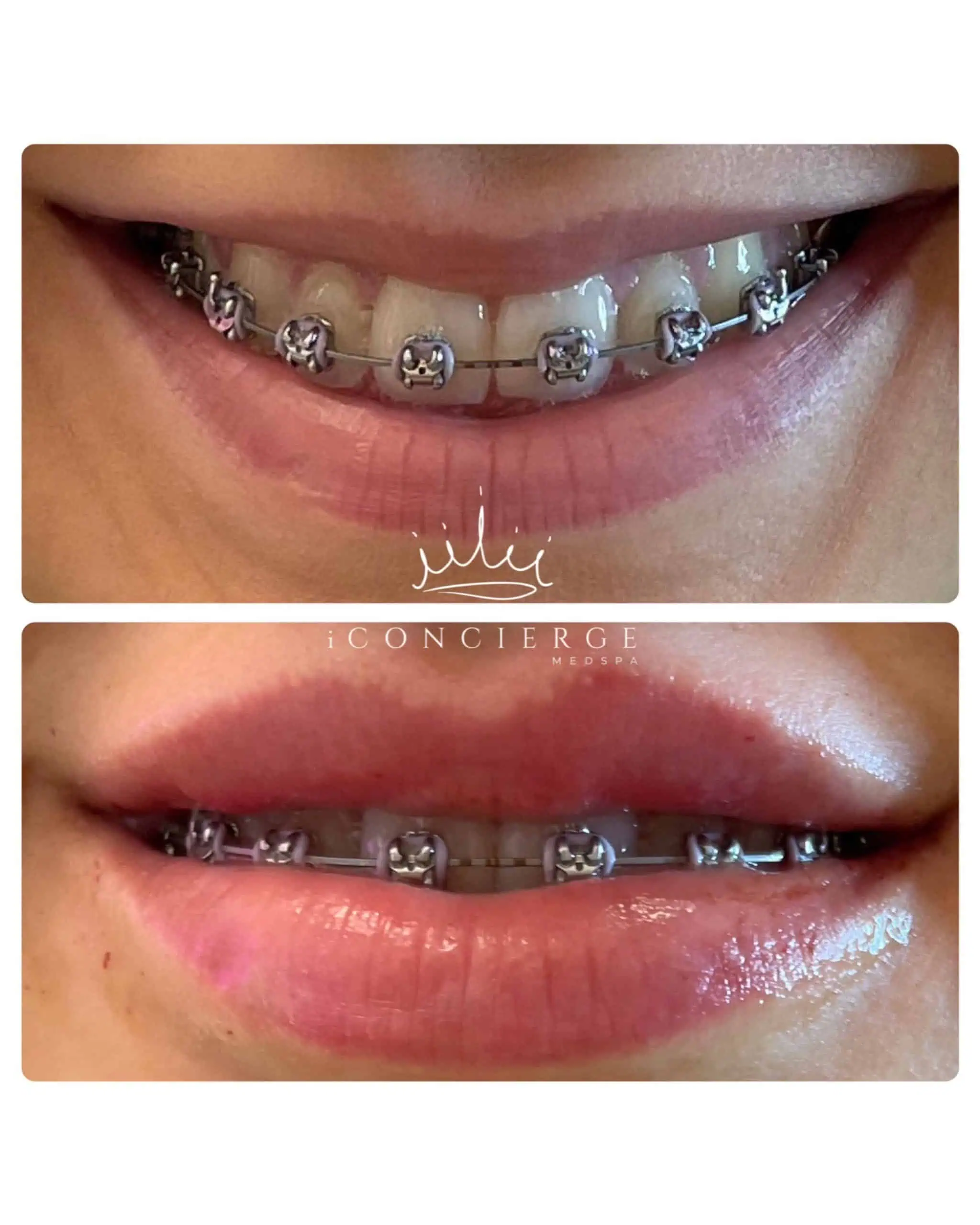 Lip Filler Before and After in St. Petersburg, FL | iConcierge Medspa